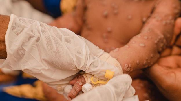 OMS: Aprobada la primera vacuna contra el mpox