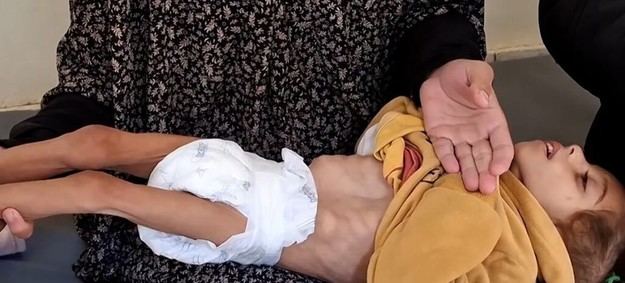 Crisis humanitaria: desnutrición infantil en Gaza y restricciones a mujeres en Afganistán